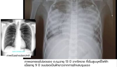 เด็กอายุ 13 สูบบุหรี่ไฟฟ้าอยู่ 4 ปี “ปอดพัง” เอ็กซ์เรย์ปอดเห็นเป็นฝ้าขาว