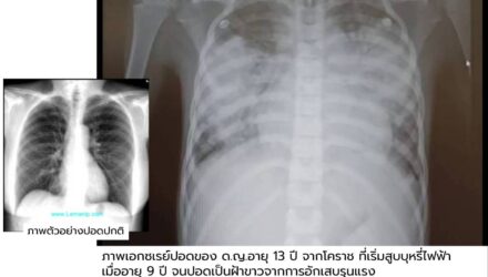 เด็กอายุ 13 สูบบุหรี่ไฟฟ้าอยู่ 4 ปี “ปอดพัง” เอ็กซ์เรย์ปอดเห็นเป็นฝ้าขาว