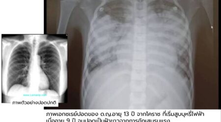 เด็กอายุ 13 สูบบุหรี่ไฟฟ้าอยู่ 4 ปี “ปอดพัง” เอ็กซ์เรย์ปอดเห็นเป็นฝ้าขาว