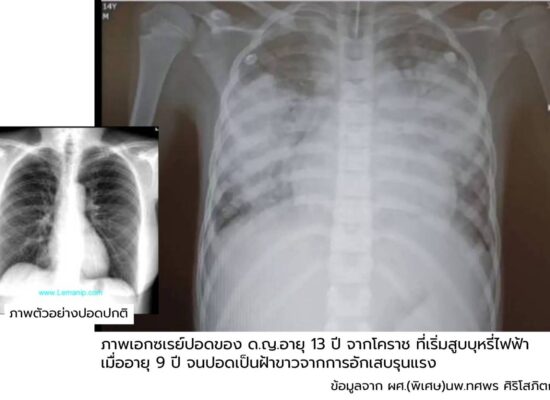 เด็กอายุ 13 สูบบุหรี่ไฟฟ้าอยู่ 4 ปี “ปอดพัง” เอ็กซ์เรย์ปอดเห็นเป็นฝ้าขาว
